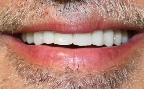 sourire-gilles-apres.jpg