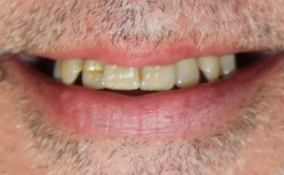 sourire-gilles-avant.jpg